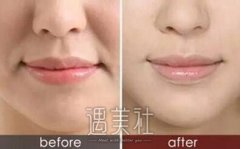 无锡鼻唇沟微整形多少钱?想甩掉多年的烦恼! width=