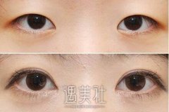 北京微创开眼角大概多少钱?听起来有点洋盘~ width=