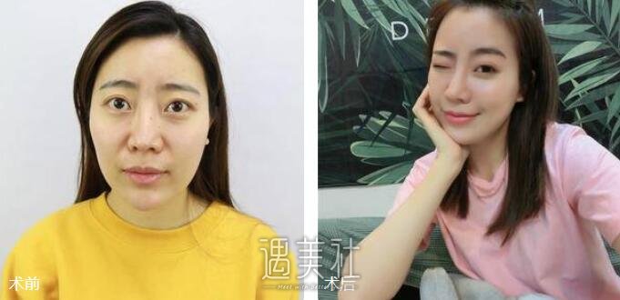像素射频除皱