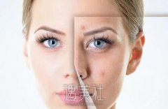 北京调节痤疮的费用大概多少呢？应该不会很贵吧？ width=