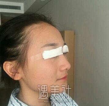 秦宏伟,双眼皮