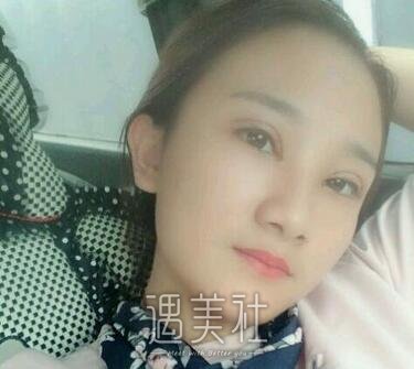 秦宏伟,双眼皮