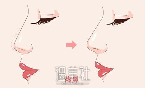 天津,伊美尔,隆鼻