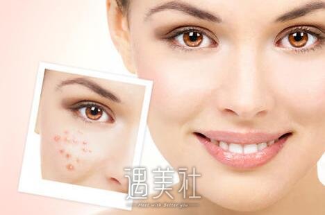 飞顿光子嫩肤