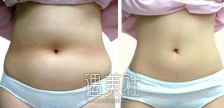 负压吸脂减肥