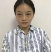 石家庄美联臣双眼皮案例：眼睛大了就是自信啊！ width=