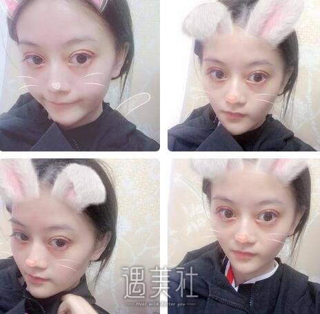 石家庄,美联臣,双眼皮