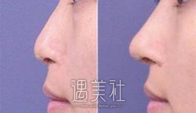 黄石分段式假体隆鼻价格是多少?听起很洋气!