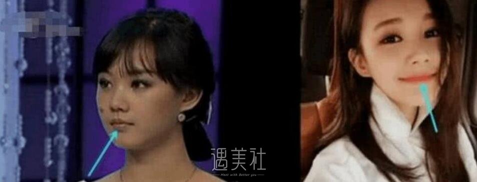 李一桐整容前后照片曝光?李一桐整容实锤了吗?