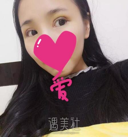 双眼皮宽度6mm案例有吗?月底想去做双眼皮宽度6mm~