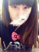 说说北京西娜李斌斌给我做的双眼皮经历，照片分享~ width=