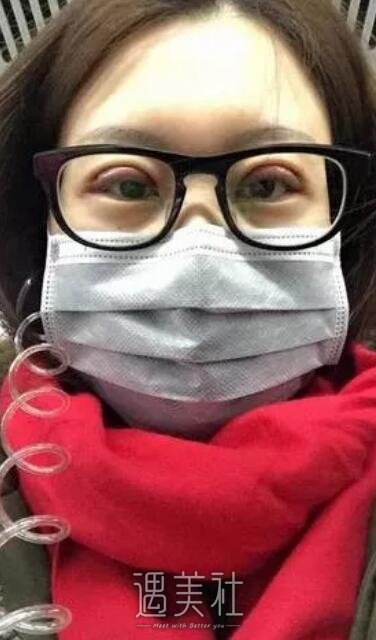 说说北京西娜李斌斌给我做的双眼皮经历，照片分享~