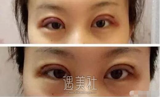 说说北京西娜李斌斌给我做的双眼皮经历，照片分享~