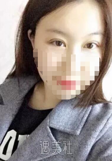 说说北京西娜李斌斌给我做的双眼皮经历，照片分享~