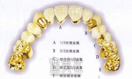 装一颗烤瓷牙大概要多少钱喃?想笑着面对世界!