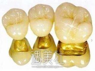 装一颗烤瓷牙大概要多少钱喃?想笑着面对世界!