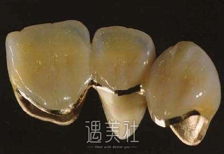 装一颗烤瓷牙大概要多少钱喃?想笑着面对世界!