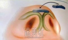 昆明低鼻尖整形大约要花多少钱?准备多少预算? width=
