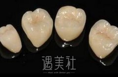 装一颗烤瓷牙大概要多少钱喃?想笑着面对世界! width=