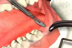 拔智齿后吃什么比较好?拔智齿后不能哪些食物呢? width=
