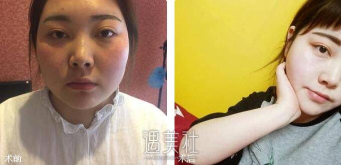 面部吸脂果图