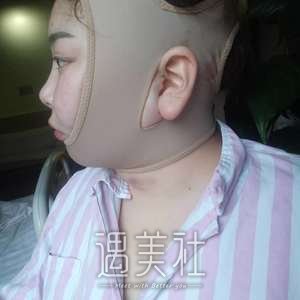 面部吸脂果图