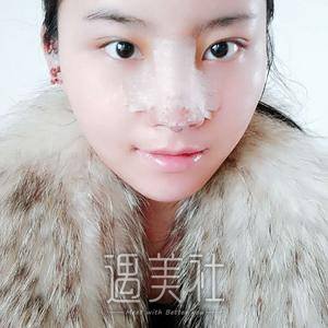 鼻尖肥大整形