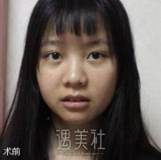 鼻翼缩小前后对比照片|鼻翼缩小术崭新日记上线~ width=
