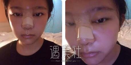 鼻翼缩小