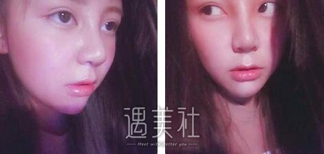 鼻翼缩小