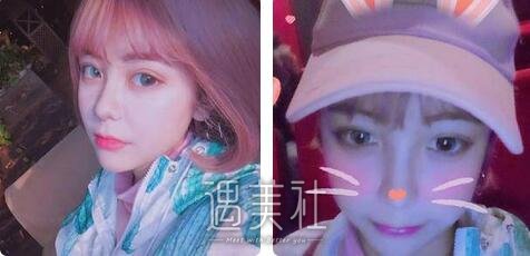 鼻翼缩小