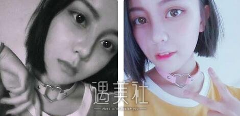 鼻翼缩小