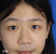 汕头伊丽莎白整形医院做眼部综合怎么样？有案例吗？ width=