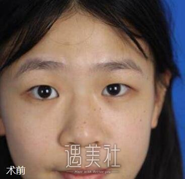汕头,伊丽莎白,眼部综合