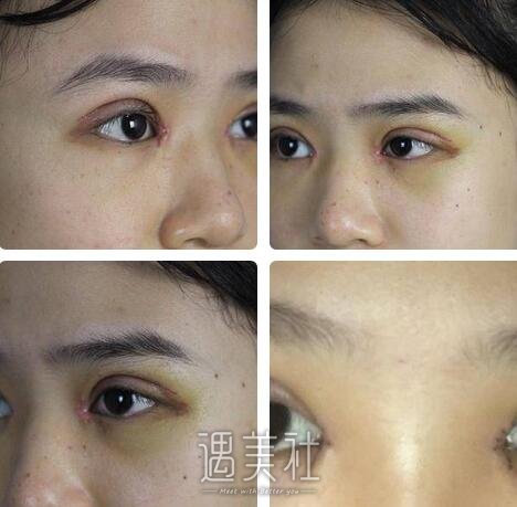汕头,伊丽莎白,眼部综合