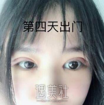 汕头,伊丽莎白,眼部综合