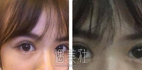 汕头,伊丽莎白,眼部综合