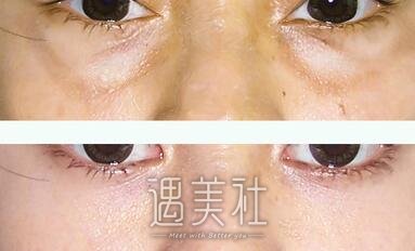 莆田,溶脂去眼袋