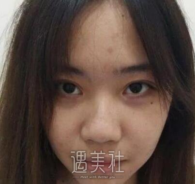 鼻孔缩小