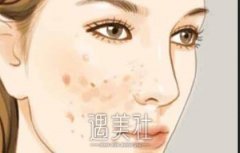 苏州激光祛斑需要多少钱？一般在哪个区间比较合理？ width=