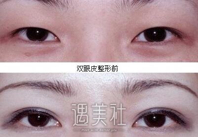 北京,割双眼皮