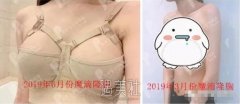 隆胸后的痛感是由哪些因素引起的？是否真的可以没多少痛感隆胸？ width=