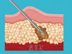 光纤溶脂术后多久可以第二次溶脂?听我慢慢讲~ width=