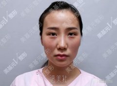 美基元整形医院做了面部脂肪填充，脸不再干瘪了~ width=