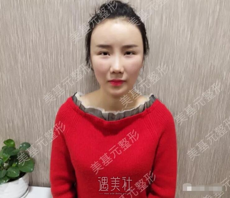 美基元整形医院做了面部脂肪填充，脸不再干瘪了~