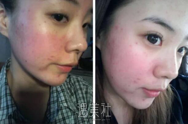 果酸换肤果图——来自果酸换肤真实案例一条~
