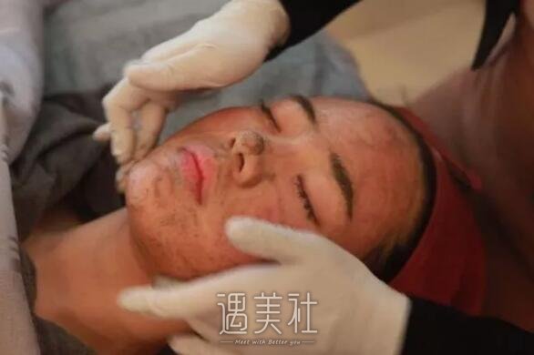 果酸换肤果图——来自果酸换肤真实案例一条~