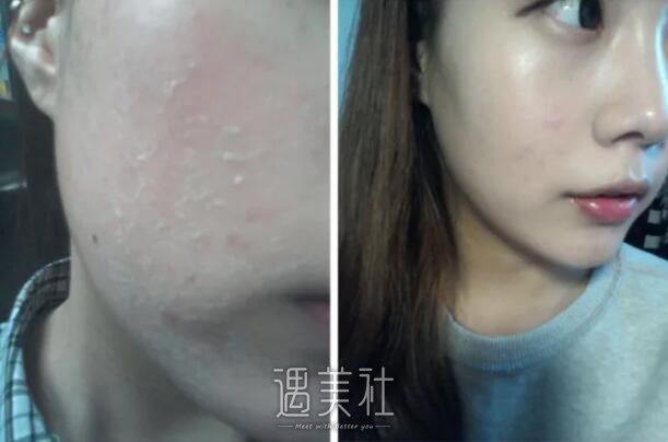 果酸换肤果图——来自果酸换肤真实案例一条~