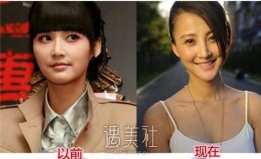 张歆艺整容前后照片不慎流出，让俺大跌眼镜呐!