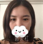 九院去眼袋怎么样?九院去眼袋真实案例力证 width=
